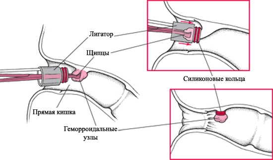 Что такое лигирование внутреннего геморроидального узла — Сайт о геморрое