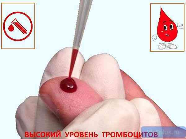 Повышены тромбоциты в крови - что это, как лечить, чем опасно