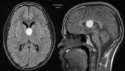Киста сосудистого сплетения головного мозга: возникновение, диагностика, лечение. Опасна ли киста сосудистого сплетения для новорожденного?