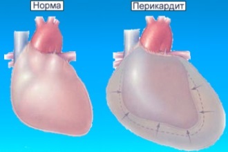Боли в области сердца при различных заболеваниях - причины, характер, лечение