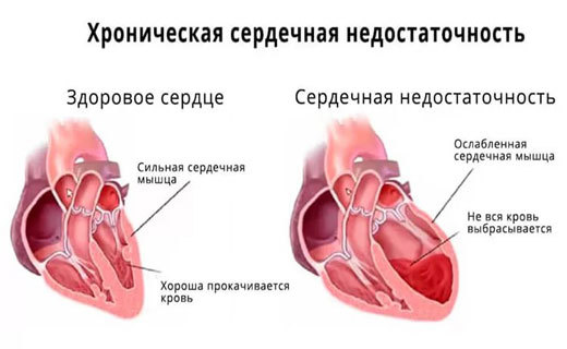Инвалидность при ИБС - советы адвокатов и юристов