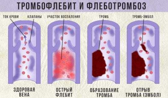 Болезни сосудов ног: причины появления и методы лечения