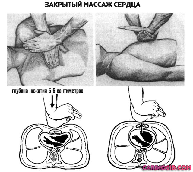 Асистолия сердца - что это такое, симптомы