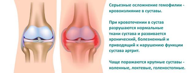 Почему гемофилия - царская болезнь
