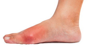 Рожа на ноге фото начальная стадия: Как начинается? - BadAcne