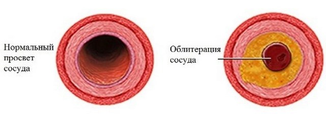 Облитерирующий эндартериит - Флебология и осложнения флебологических проблем