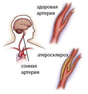 Операция на сонной артерии при атеросклерозе