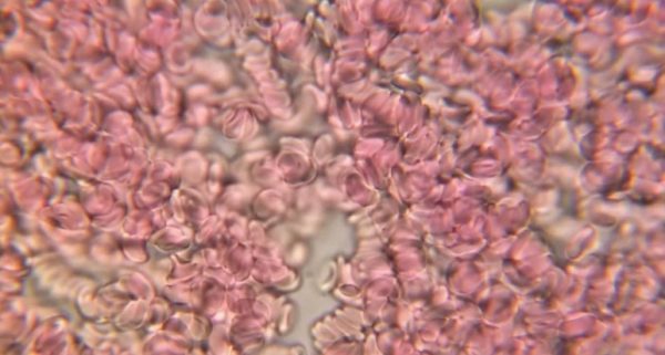 Анализ крови при лейкозе. Какие изменения в крови вызывает лейкоз. Биохимический анализ крови.