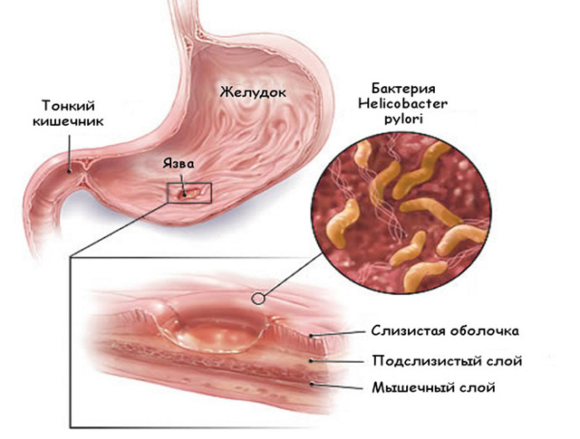 Нексиум - 17 отзывов, инструкция по применению