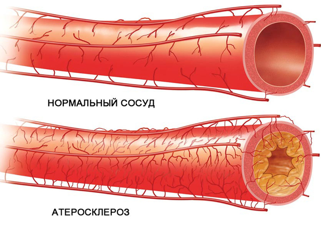 Как почистить сосуды? 5 лучших рецептов очищения сосудов головного мозга. Лекарственные средства и препараты