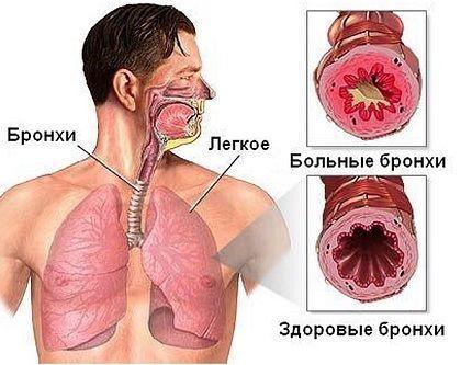 Прожилки крови в мокроте при кашле