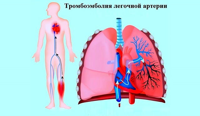 Тромбоэмболия - что это такое: признаки, диагностика и профилактика