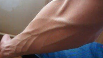 Почему видны вены на руках и как их убрать?