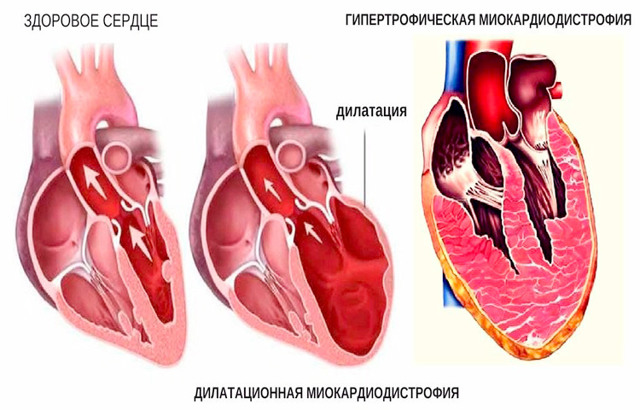 Симптомы и лечение дистрофии миокарда