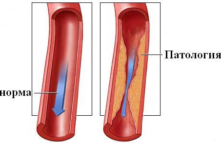 Спазм сосудов головного мозга