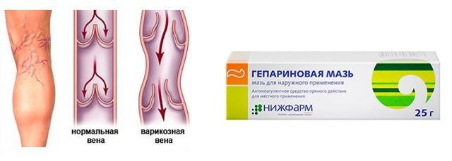Гепариновая мазь при варикозе ног на сайте варикоз