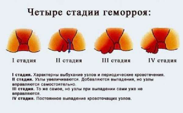 Тромбоз наружного геморроидального узла: причины и лечение