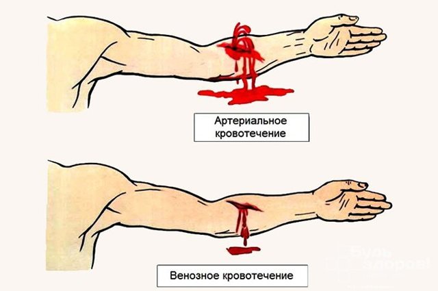 Кровотечение - симптомы, формы, причины, диагностика, лечение