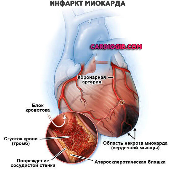 Инфаркт миокарда восстановление