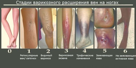 УЗИ сосудов (артерий и вен) нижних конечностей – показания и основы процедуры