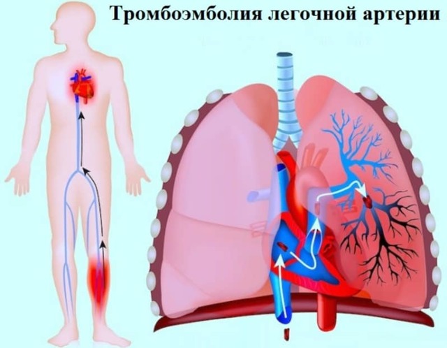 Тромб в легких: тромбоз легочной вены – симптомы и лечение