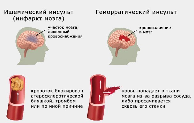 Чем отличается инфаркт миокарда от инсульта головного мозга