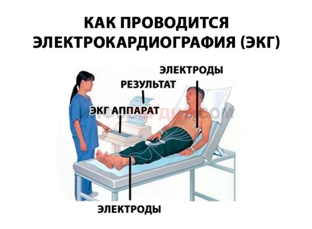 Синусовый ритм сердца: что это, ЭКГ, нарушения ритма