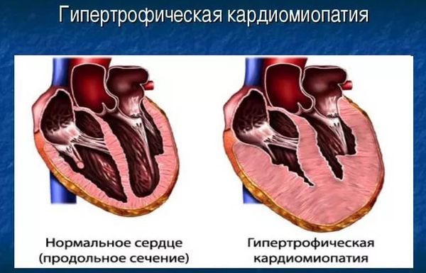 Гипертрофическая кардиомиопатия.