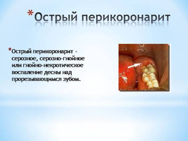 Перикоронарит зуба мудрости - формы, симптомы и лечение
