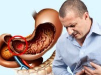 Классификация желудочно-кишечных кровотечений Форрест — Superfb