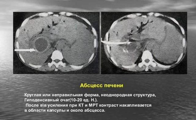 Абсцесс печени: диагностика, симптомы и лечение