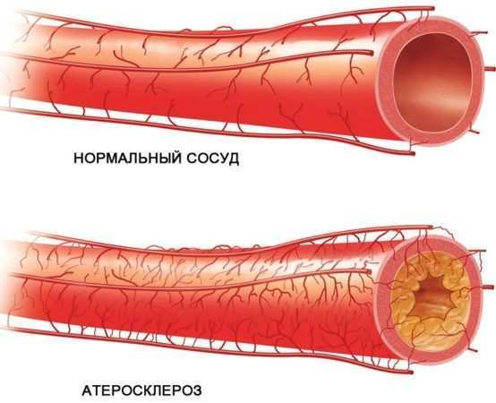 Операция на сонной артерии при атеросклерозе