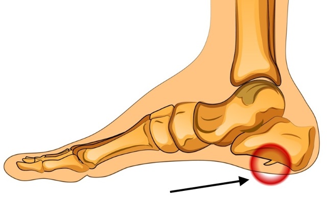 Пяточная шпора - симптомы и лечение в домашних условиях эффективными способами