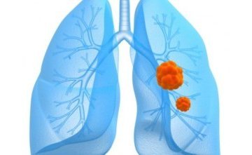 Характерные симптомы легочной гипертензии и схемы лечения