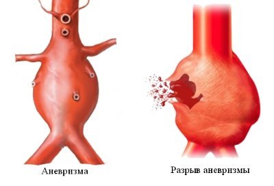 Аневризма грудного отдела аорты: диагностика и лечение