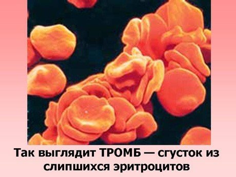 Тромбоциты повышены в крови у взрослого, о чем это говорит