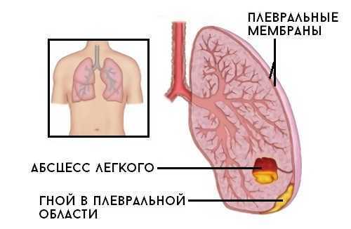 Бактериологический посев крови. Микробиологическое исследование. Гемокультура. Посев (Культура) крови. Стерильность крови. Диагностика. Анализы. Бектериемия и Фунгемия. Интерпретация результатов