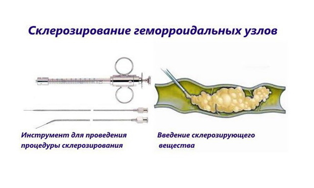 Узлы в прямой кишке - Геморроидальные узлы