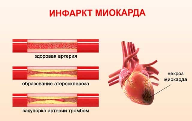 Повторный инфаркт миокарда: признаки, профилактика