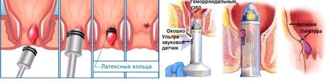 Лечение геморроя без операции: эффективные методы