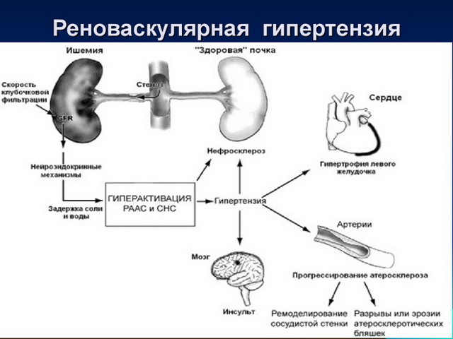 Реноваскулярная гипертензия - лечение, причины