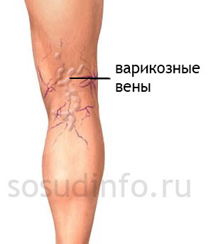 Выступают вены на руках у женщин и мужчин: причины, лечение сильно выпирающих вен