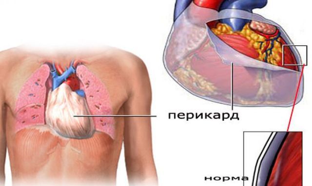 Перикардит: симптомы, лечение