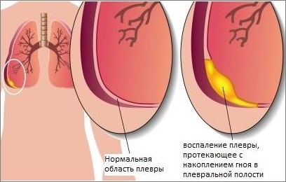 Плеврит легких, симптомы и лечение заболевания