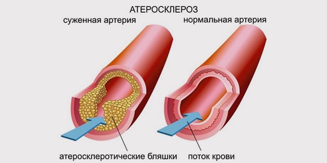 Сколько живут после инсульта - как жить после инсульта?