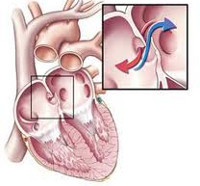 Овальное окно у детей - причины, симптомы и лечение
