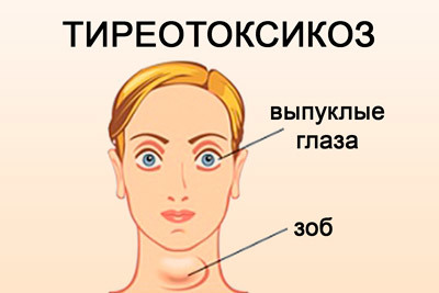 Экстрасистолы по типу бигеминии