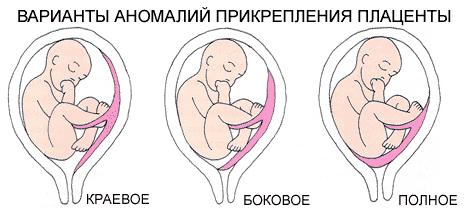 Нарушение плацентарное - причины появления симптома, способы лечения