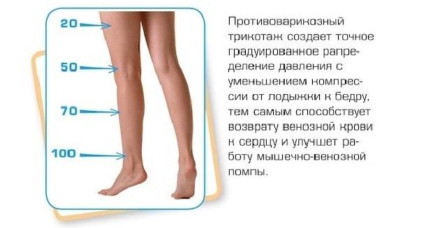 Как лечить варикоз на ногах у женщин народными средствами