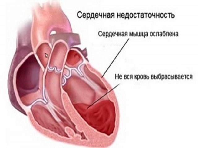 Левое предсердие увеличено что это значит — Сердце